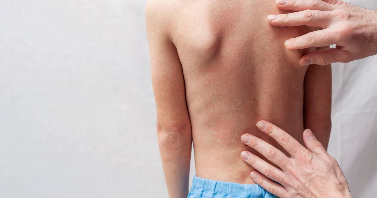 UKHSA alert over highly contagious illness