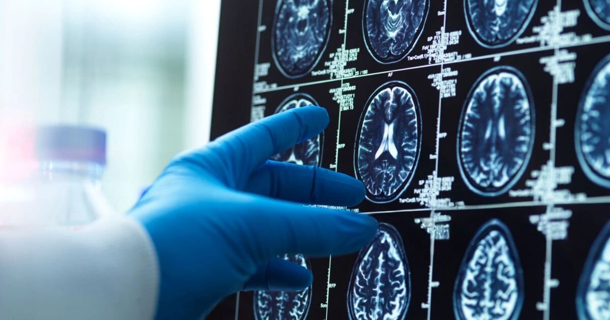 Advanced Alzheimer’s breakthrough offers hope it could be reversed