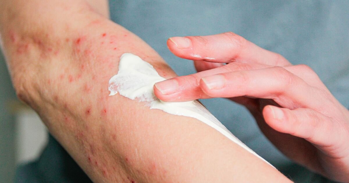 The 5 shingles red flags to know as rashes ‘surge by 50%’