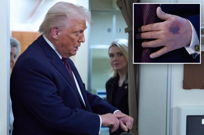 Trump-blames-hand-bruise-at-Davos-on-aspirin.jpg