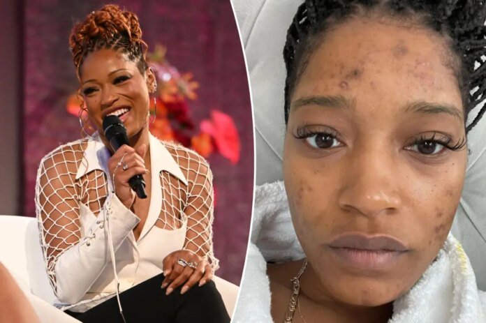 Keke-Palmer-details-condition-that-left-her-with-‘cracked-glass.jpg